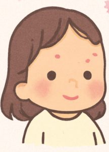 明里ちゃんの水ぼうそう