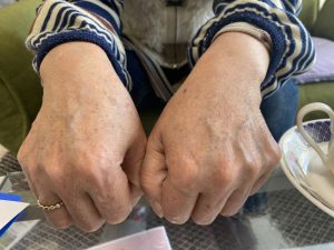 アトピーの手　初宝石岩盤浴