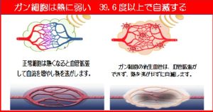 傍腫瘍症候群　ガンの完治前