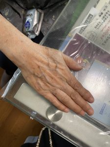 80歳の手　指が真っ直ぐに！