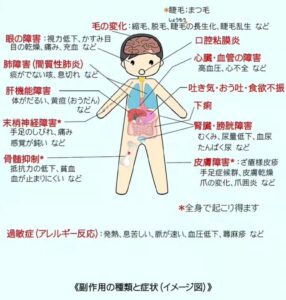 抗がん剤　うつみん